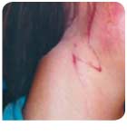 Schnittverletzung vorher