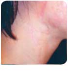 Schnittverletzung nachher