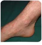 Verbrennung nach der Behandlung