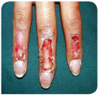 Verbrennung vor der Behandlung